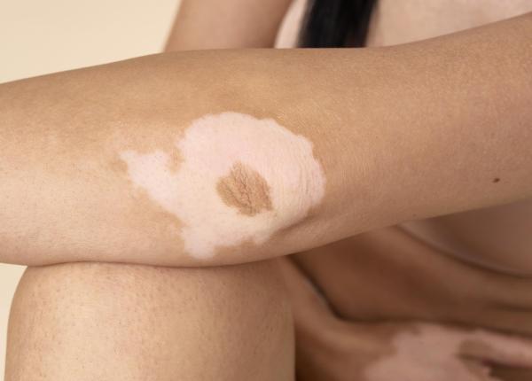 vitiligo cauze simptome tratament ce presupune stabilirea unui diagnostic