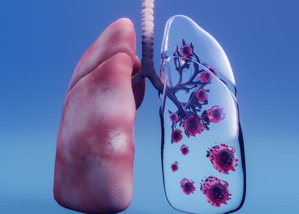 cancer plamani ioan cordos sanador ct radiografie