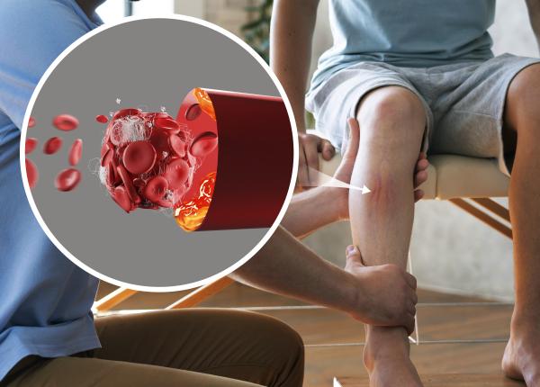 tromboza venoasa profunda diagnostic tromboza venoasa profunda diagnostic