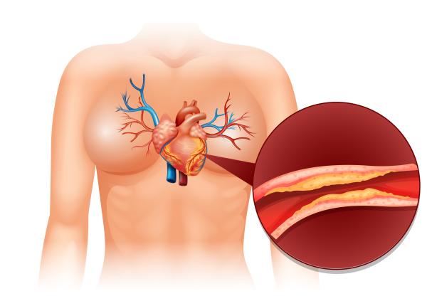 diferenta dintre preinfarct si infarct primul semn care apare la preinfarct diferenta dintre preinfarct si infarct primul semn care apare la preinfarct