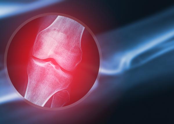 testul care pune diagnosticul de ruptura de menisc dr razvan dragomir testul care pune diagnosticul de ruptura de menisc dr razvan dragomir