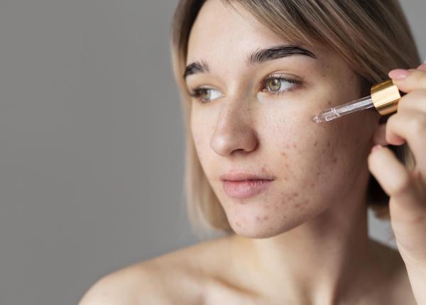 remedii naturale pentru acnee