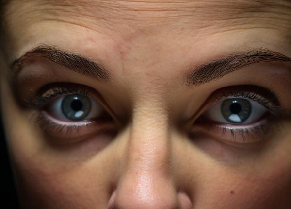 cum sa scapi de cearcane blefaroplastia