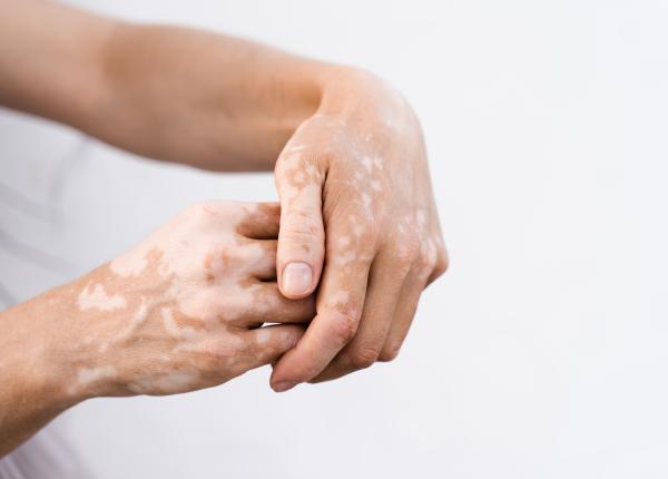 vitiligo cauze tratament si complicatii vitiligo cauze tratament si complicatii