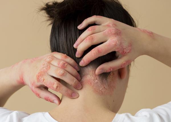 cauza care duce la aparitia psoriazisului cercetatorii australieni anunta ca au descoperit o asta alimenteaza boala