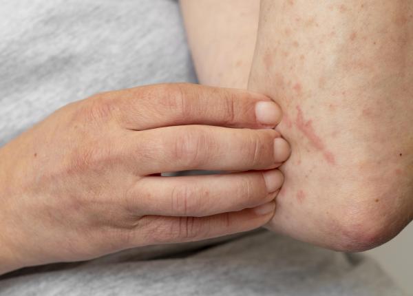 ce este dermatita atopica care sunt optiunile de tratament ce este dermatita atopica care sunt optiunile de tratament