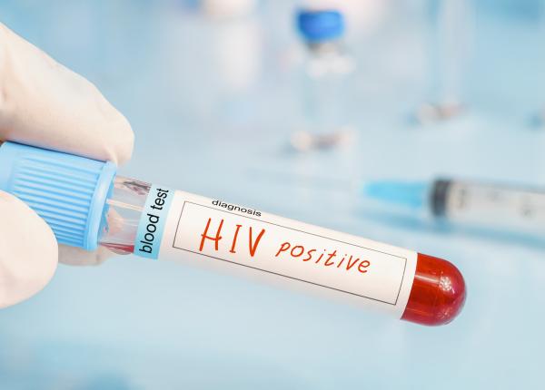 sida redenumita in hiv avansat
