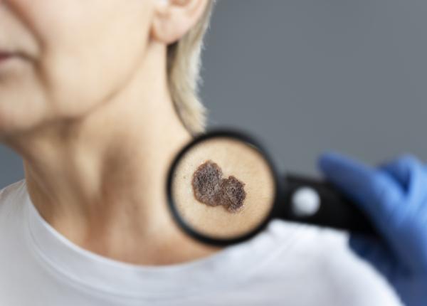 vaccinul pentru cancerul de piele in teste vaccinul pentru cancerul de piele in teste