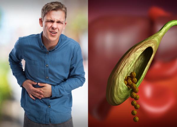 calculii biliari cauze simptome si optiuni de tratament