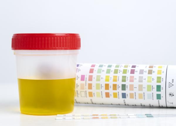 un simplu test de urina ar putea ajuta la evitarea biopsiilor inutile pentru cancerul de prostata un simplu test de urina ar putea ajuta la evitarea biopsiilor inutile pentru cancerul de prostata
