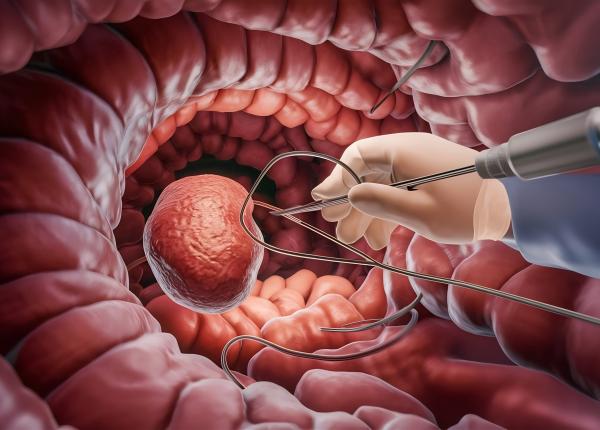 cand este indicata colonoscopia cand este indicata colonoscopia