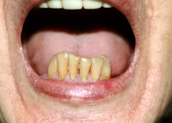 ce este parodontoza si cum poate fi tratata