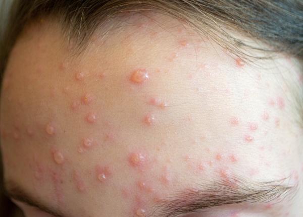 cum sa scapi repede de varicela cele 4 metode usoare medicii explica de ce e bine sa faci baie la varicela cum sa scapi repede de varicela cele 4 metode usoare medicii explica de ce e bine sa faci baie la varicela