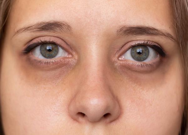 cum sa scapi de cearcane