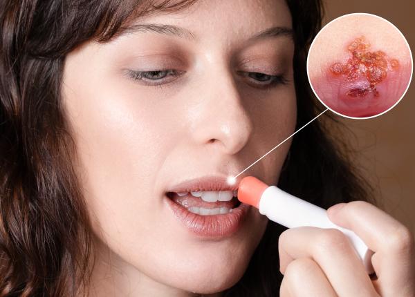 herpes cum sa scapi de herpes in cateva ore 7 remedii naturiste acasa