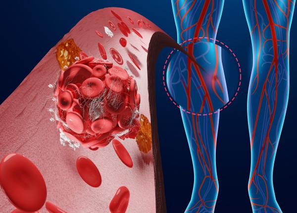 ateroscleroza in diabet complicatii majore