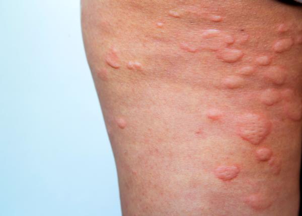 psoriazis 8 dintre cele mai frecvente locuri pentru placile de psoriazis psoriazis 8 dintre cele mai frecvente locuri pentru placile de psoriazis
