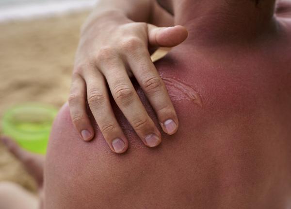 cum calmezi pielea arsa de soare 5 metode secrete dermatologi cum calmezi pielea arsa de soare 5 metode secrete dermatologi