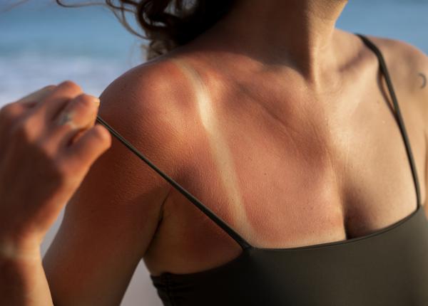 varsta la care arsura solara e cea mai periculoasa de ce unii se ard altii se bronzeaza dr olga simionescu atunci chiar e o nenorocire varsta la care arsura solara e cea mai periculoasa de ce unii se ard altii se bronzeaza dr olga simionescu atunci chiar e o nenorocire
