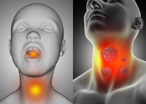 amigdalita tot ce trebuie sa stiti simptome tratament