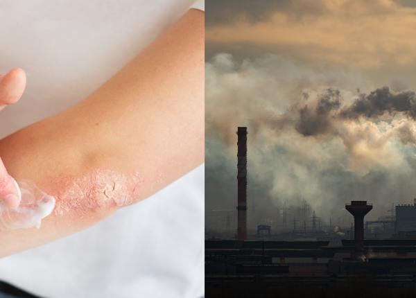 poluarea aerului un factor major in dezvoltarea psoriazisului poluantii atmosferici cresc riscul de psoriazis cu pana la 47prc poluarea aerului un factor major in dezvoltarea psoriazisului poluantii atmosferici cresc riscul de psoriazis cu pana la 47prc
