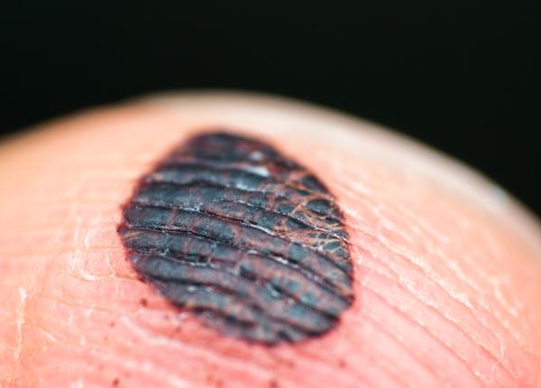 melanom cancer tineri arsura solara melanom cancer tineri arsura solara