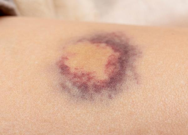 hematom cauze si simptome cand o vanataie este periculoasa