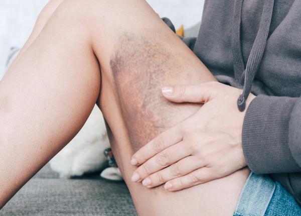 contuzii cum afecteaza corpul si ce optiuni de tratament exista