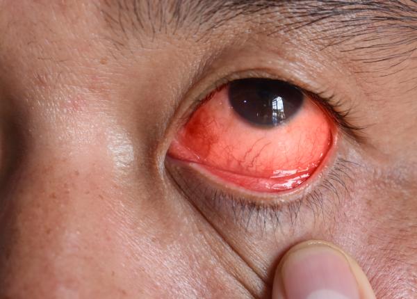 hifema acumularea de sange din ochi poate cauza probleme de vedere permanente hifema acumularea de sange din ochi poate cauza probleme de vedere permanente