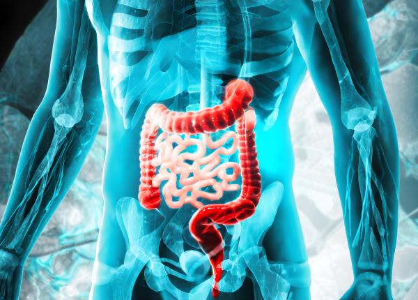 factorii care contribuie la cresterea incidentei cancerului de colon la tineri importanta screeningului precoce in prevenirea cancerului de colon