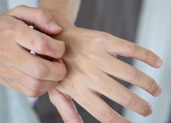fda a aprobat lebrikizumab pentru dermatita atopica fda a aprobat lebrikizumab pentru dermatita atopica