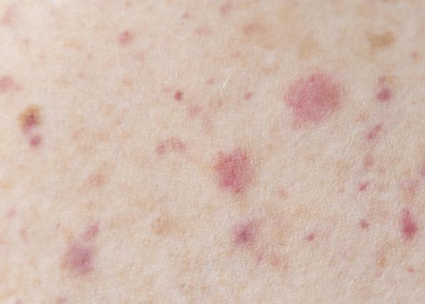 crisugabalin efect in nevralgia post herpetica zoster