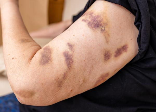 vanatai si vase de sange sparte pe piele ce se intampla in corpul tau semnul dat de aceste vanatai vanatai si vase de sange sparte pe piele ce se intampla in corpul tau semnul dat de aceste vanatai