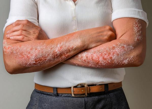 400 000 de romani sufera de psoriazis dar doar 14 685 sunt inscrisi in registrul national de boli dermatovenerice varsta de debut e intre 16 22 de ani si 57 60 de ani 400 000 de romani sufera de psoriazis dar doar 14 685 sunt inscrisi in registrul national de boli dermatovenerice varsta de debut e intre 16 22 de ani si 57 60 de ani