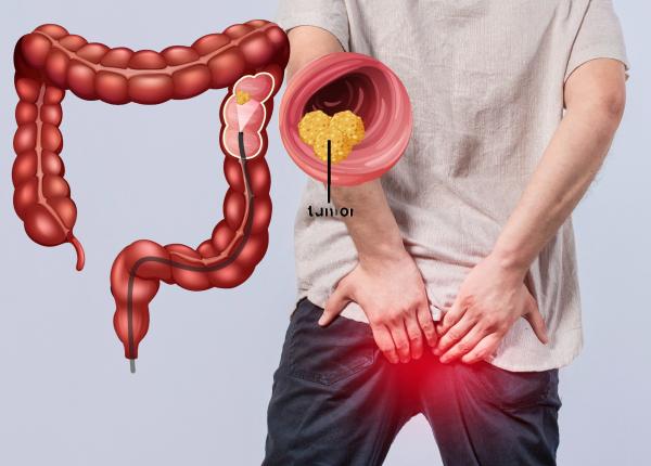 credea ca are un hemoroid dar diagnosticul l a socat avea cancer de colon in stadiul 4 cu metastaze la ficat au observat doua tumori diferite