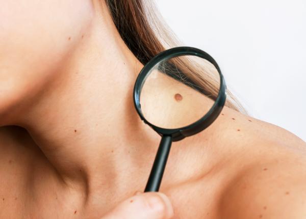 alunitele si petele pigmentare care e diferenta si cand trebuie sa mergi la medic primul semn ca ai o alunita periculoasa alunitele si petele pigmentare care e diferenta si cand trebuie sa mergi la medic primul semn ca ai o alunita periculoasa
