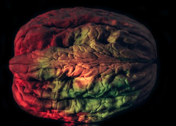 ce este astrocitomul tumora agresiva foarte frecventa vlad ciurea diagnosticul este mult mai simplu prin spectroscopie ce este astrocitomul tumora agresiva foarte frecventa vlad ciurea diagnosticul este mult mai simplu prin spectroscopie