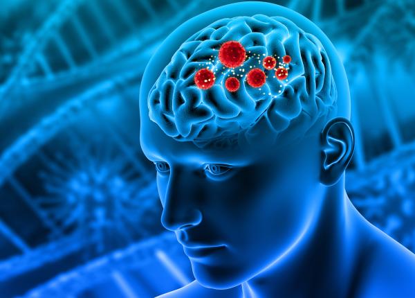testul care detecteaza anevrismul cerebral inainte sa se rupa vlad ciurea acesta e simptomul ca se rupe apare in jur de 40 de ani la cei activi si stresati testul care detecteaza anevrismul cerebral inainte sa se rupa vlad ciurea acesta e simptomul ca se rupe apare in jur de 40 de ani la cei activi si stresati
