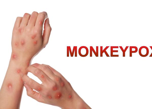 autoritatile au declarat stare de urgenta sanitara de mpox