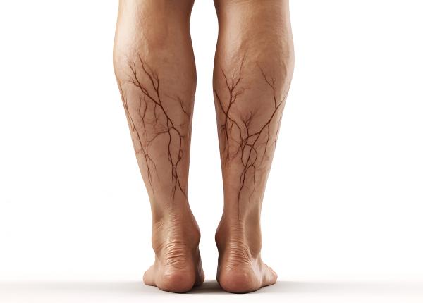 terapia cu lumina rosie solutie pentru prevenirea cheagurilor de sange mortale