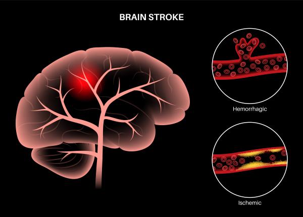 tratamentul pentru avc ischemic dr cristian pandrea dizolva cheagul de sange tratamentul pentru avc ischemic dr cristian pandrea dizolva cheagul de sange