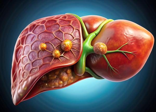 udca suplimentul dietetic in tratamentul cancerului hepatic udca suplimentul dietetic in tratamentul cancerului hepatic