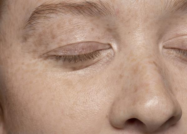 care este diferenta dintre petele de varsta si petele solare acestea se transforma in cancer de piele care este diferenta dintre petele de varsta si petele solare acestea se transforma in cancer de piele