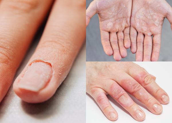 ai aceste semne pe piele sunt semnul ca ai o forma agresiva de cancer ai aceste semne pe piele sunt semnul ca ai o forma agresiva de cancer