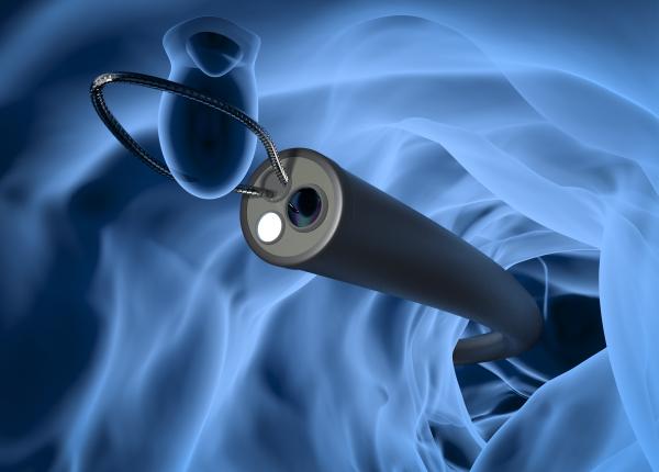 cancerul colorectal ataca tot mai multi tineri dr dana braic nu vin de frica dar colonoscopia salveaza cancerul colorectal ataca tot mai multi tineri dr dana braic nu vin de frica dar colonoscopia salveaza