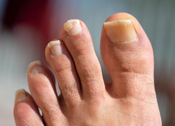 infectii fungice unghii greseli zilnice care iti distrug unghiile pasi simpli pentru unghii sanatoase infectii fungice unghii greseli zilnice care iti distrug unghiile pasi simpli pentru unghii sanatoase