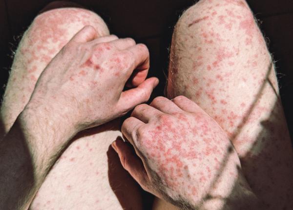 epidemie de rujeola cum sa te feresti de boala trebuie sa ne revaccinam epidemie de rujeola cum sa te feresti de boala trebuie sa ne revaccinam