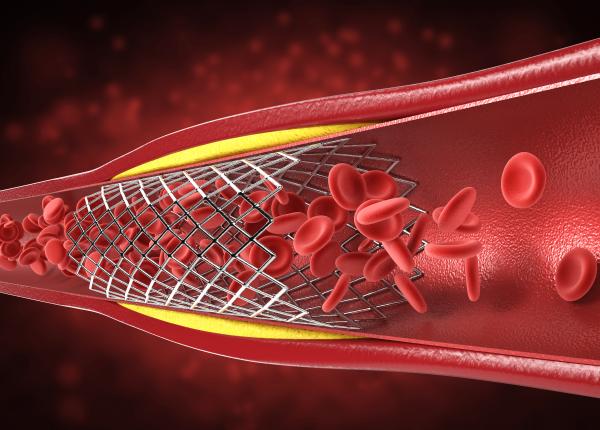 colesterolul ridicat si riscurile bolii arteriale periferice semnele care nu trebuie ignorate colesterolul ridicat si riscurile bolii arteriale periferice semnele care nu trebuie ignorate