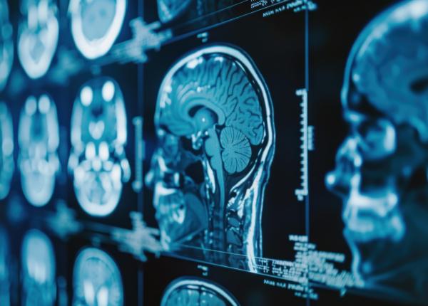 un nou indiciu in alzheimer boala ar putea fi legata de vasele de sange nu doar de creier un nou indiciu in alzheimer boala ar putea fi legata de vasele de sange nu doar de creier