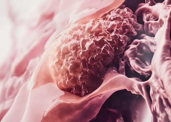 semnele timpurii ale melanomului nu doar forma alunitei conteaza semnele timpurii ale melanomului nu doar forma alunitei conteaza